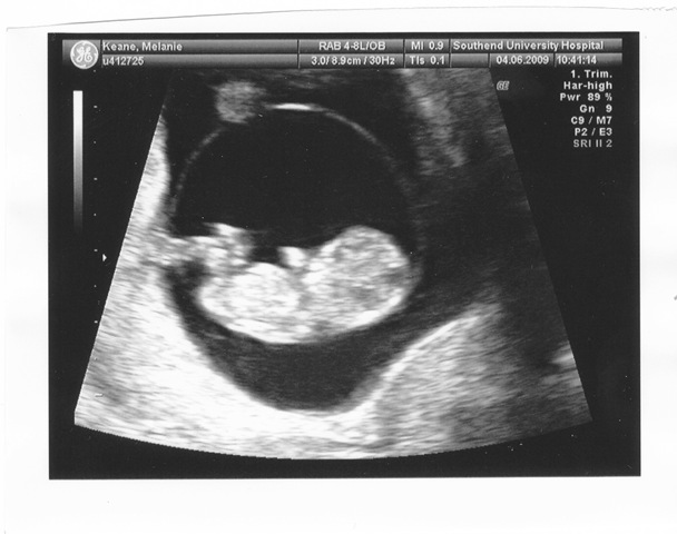 [Baby 10 weeks[3].jpg]