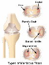 meniscustears