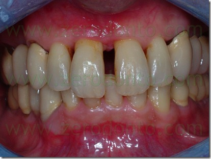 diastema incisivo