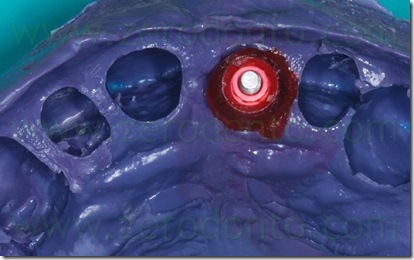 impronta implantare modificata