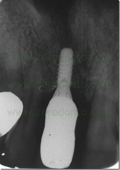 impianto zona estetica straumann