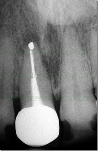 Apicectomia endodonzia chirurgica Apicectomia endodonzia chirurgica