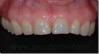 faccette ceramica feldspatica