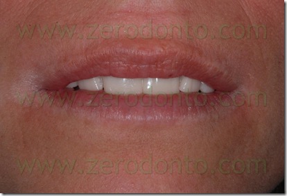 wax-up