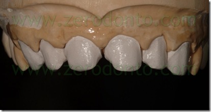 massa dentina