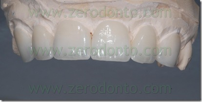 ceramica dentina