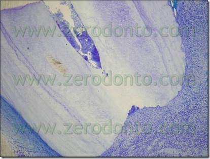 tetraclean canale radice
