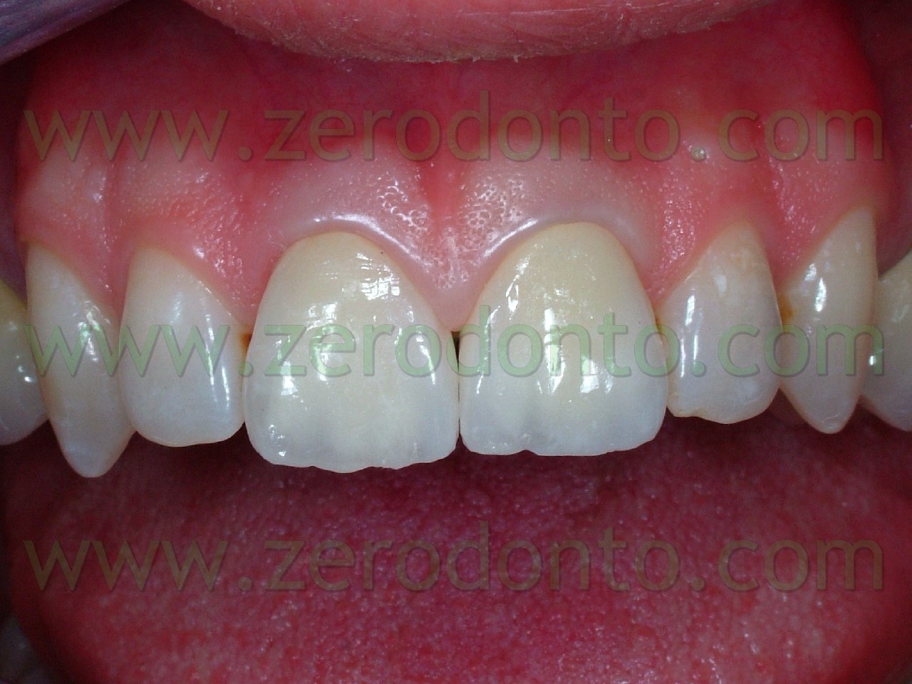 [dente 11 in ceramica bis[4].jpg]