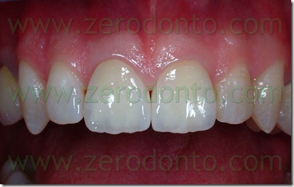 corone anteriori in zirconia-ceramica