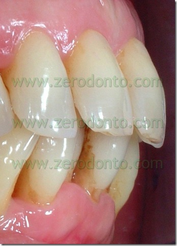 overjet e overbite