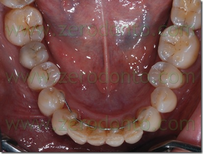 allineamento dentario invisibile