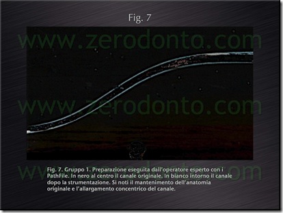 sagomatura canali endodonzia sagomatura canali endodonzia