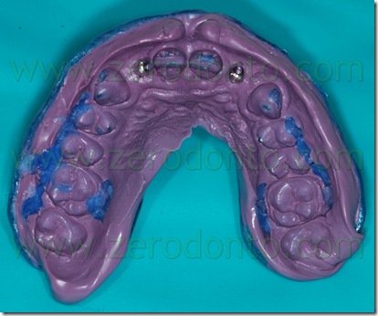 impronta silicone