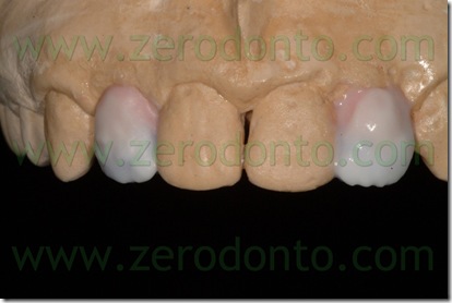 stratificazione porcellana dentale