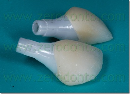 impianto corona ceramica integrale