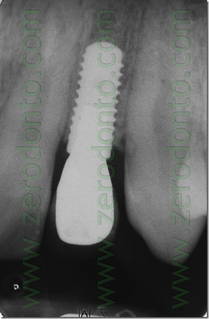 radiografia bone level