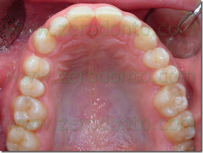 occlusale superiore