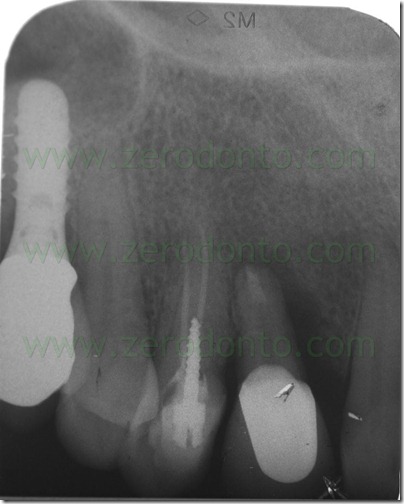 split crest controllata con chirurgia sonica