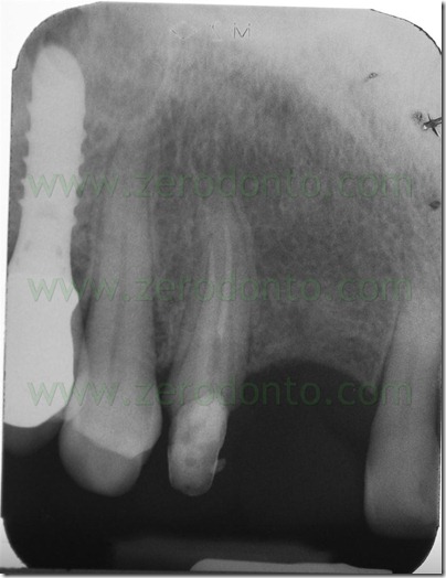 split crest controllata
