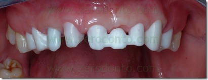 zirconia