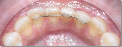 gingival inflammation