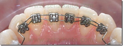 self ligating