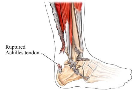 [achilles tendon2[4].jpg]