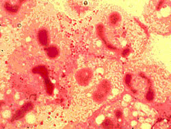 Meningite.jpg