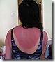 75px-Sunburn2[1]