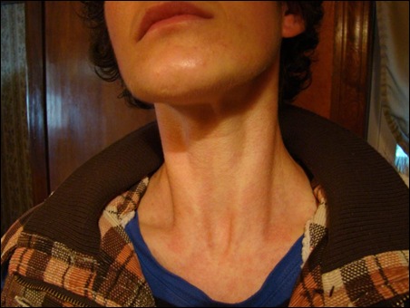 hives2