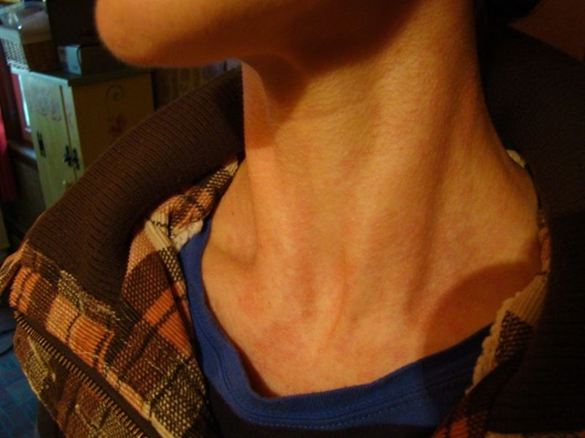[hives3[5].jpg]