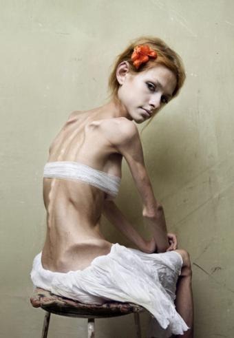 [bulimia-anorexia[3].jpg]