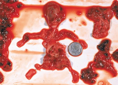 [aborted_9_week_fetus[2].jpg]