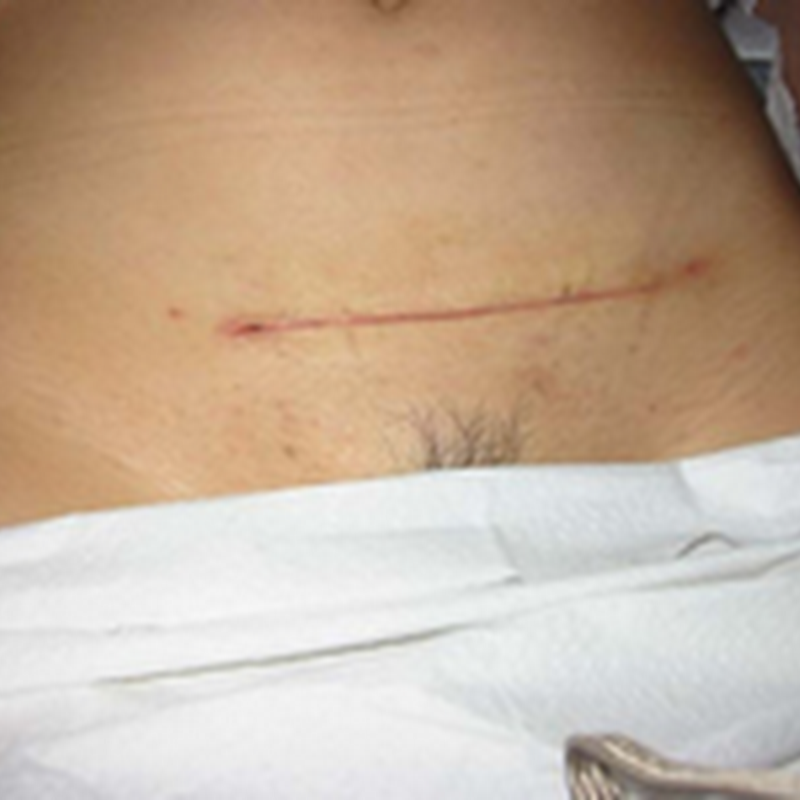 ACUTE ABDOMEN Part 03