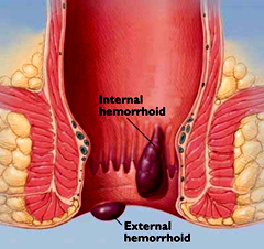 HEMORRHOIDS 