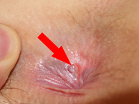 ANAL FISSURES 
