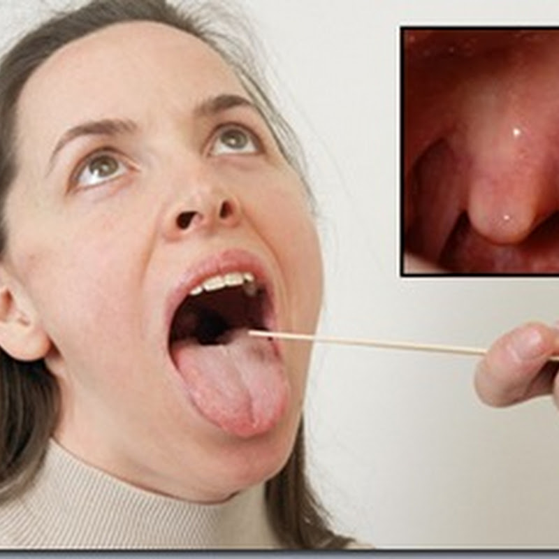 Calcoli tonsillari: Trattamento e rimedi ai calcoli tonsillari
