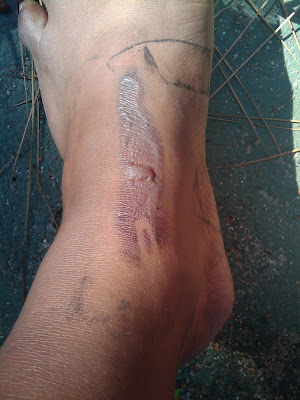 My leg today