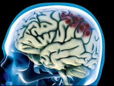 Imagem de exame de dano cerebral