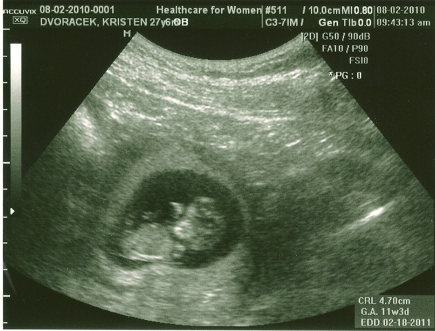 [Baby11Weeks0002[2].jpg]