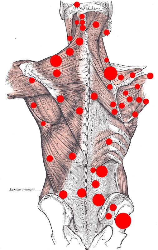 Fig409BackMusclesTrP.jpg