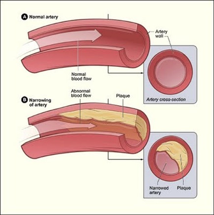 atherioclerosis atherioclerosis