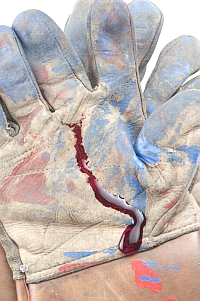 Image of an emergency service workers blood stained glove