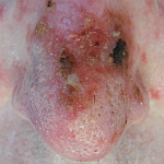 Reaction to two weeks of Aldara skin cancer treatment to the nose