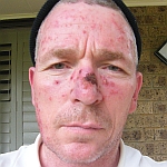 Facial skin reaction after two weeks of Aldara skin cancer treatment - front view image