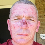 Aldara treatment reaction to face