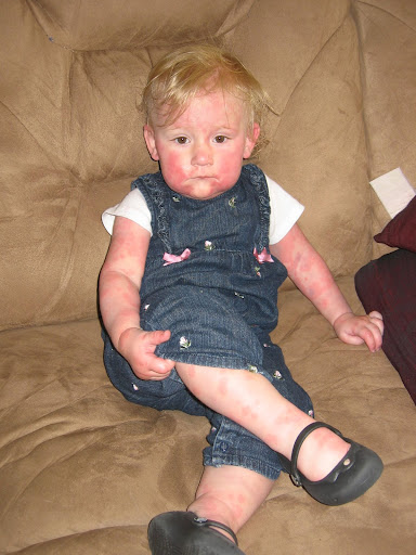amoxil rash