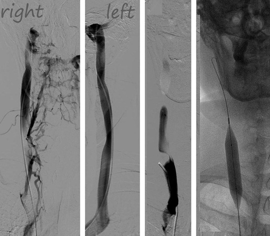 [2475295_MS_venogram r and l jugulars[9].jpg]