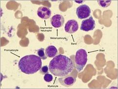 Blast-promyelocyte-myelocyte-metamelocyte-band-segmented-100x-website-arrow