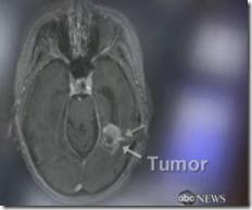Cancer Symptoms Weakness In Legs Cancer Symptoms Weakness In Legs